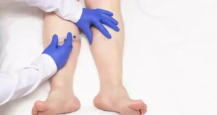 Foam Sclerotherapy for Varicose Vein Treatment: What is it?
