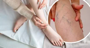 What Happens If Varicose Veins Are Not Treated?